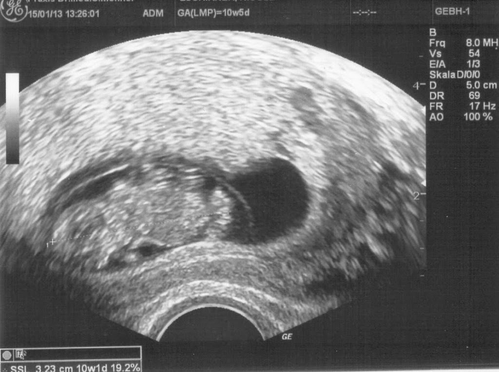 Abtreibung 11 Woche